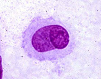 Histiocytoma cell with a nuclear cleft and typical butt cell morphology.